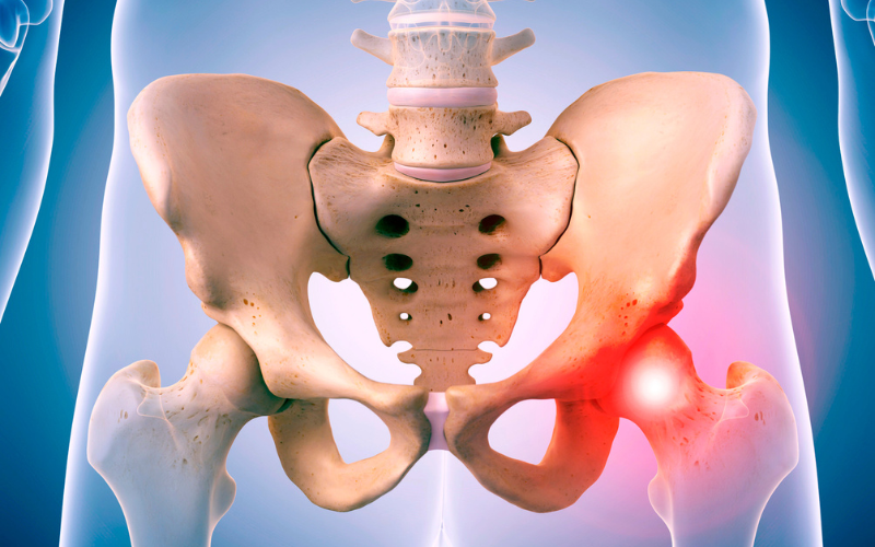 hip impingement