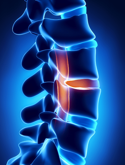 Spinal Infection Doctors in Elkhart, IN Back pain - Spine Pain - chronic spine pain - chronic spinal disc problems - OSMC - orthopedics - orthopedic surgery Elkhart IN - orthopedic surgery Goshen IN - orthopedic surgery Middlebury IN - orthopedic surgery Nappanee IN - orthopedic center near me - orthopedic clinic near me - orthopedic doctor