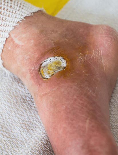 Diabetic Foot Foot and Ankle Pain - ankle pain treatment near me - Podiatrists - OSMC - orthopedics - orthopedic surgery Elkhart IN - orthopedic surgery Goshen IN - orthopedic surgery Middlebury IN - orthopedic surgery Nappanee IN - orthopedic center near me - orthopedic clinic near me - orthopedic doctor